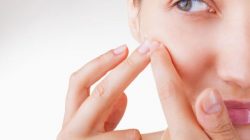 Nặn mụn ở Vichy Spa có tốt không? Tips chăm sóc da mụn đúng cách